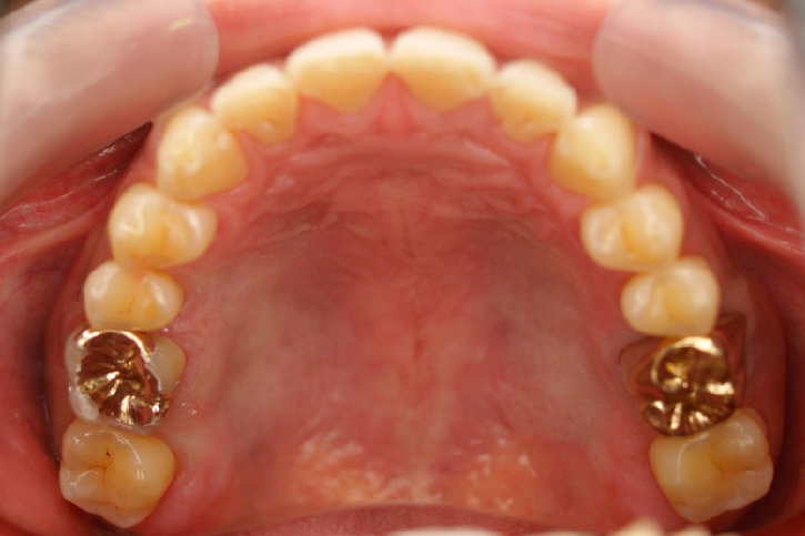 千葉市中央区 T.S様 左右6番ゴールドインレー・クラウン修復 ｜ 作品